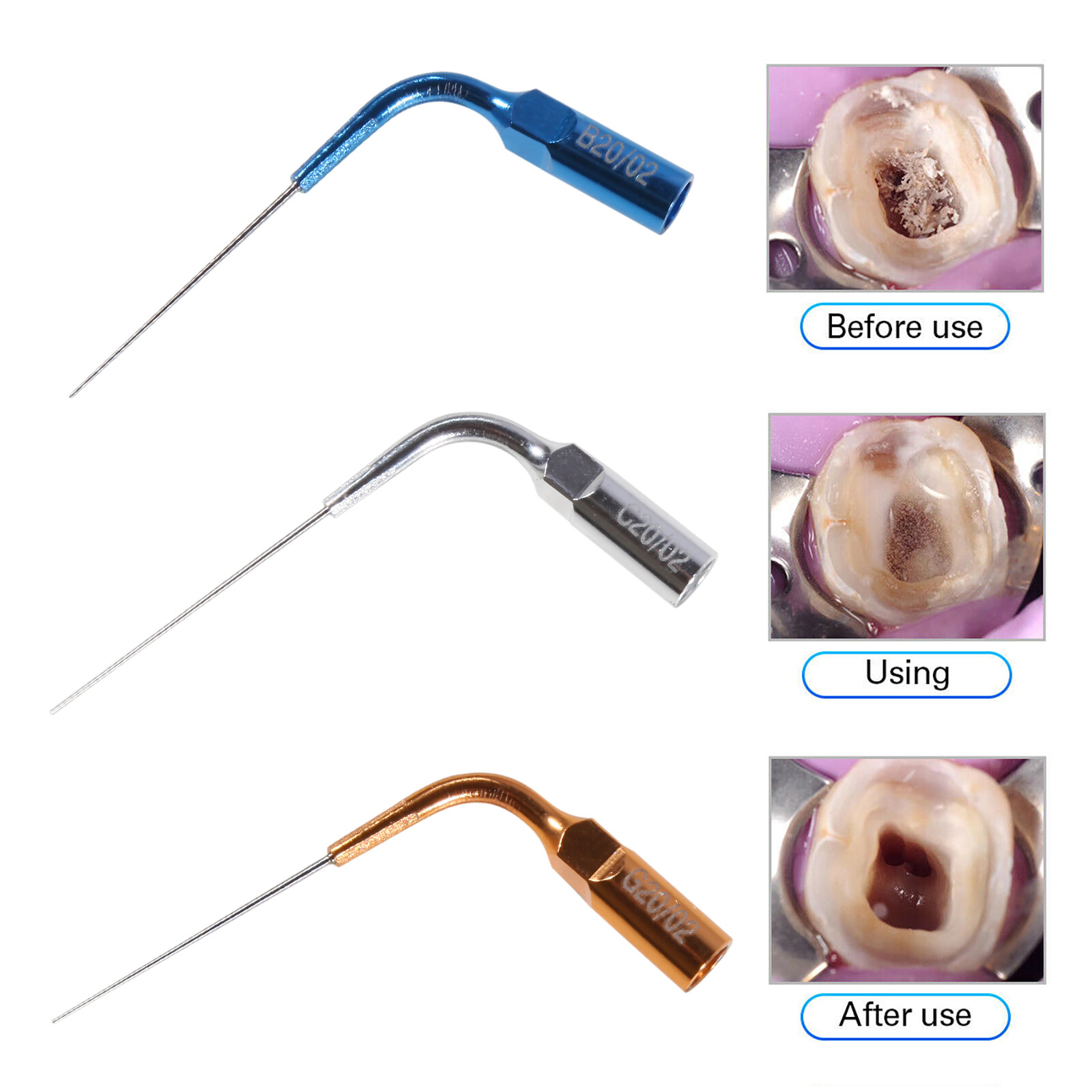 Tips for Dental Endo Ultra Activator Ultrasonic Irrigator Root Canal Handpiece
