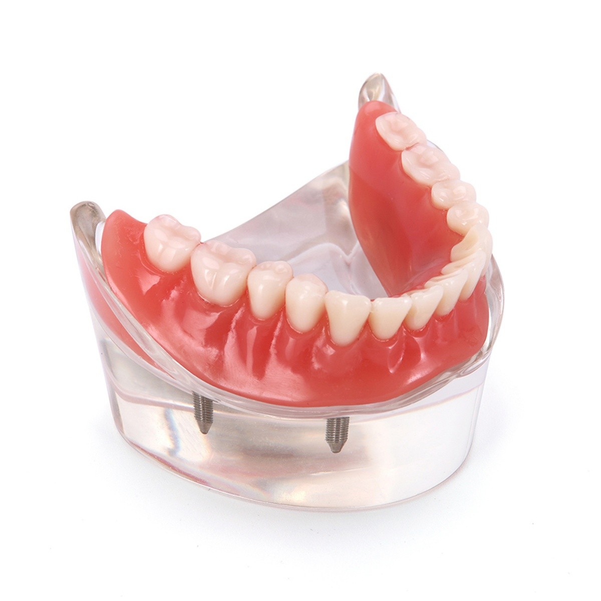 4 Implants Upper Lower Implant Teeth Model Dental Overdenture Restoration Model