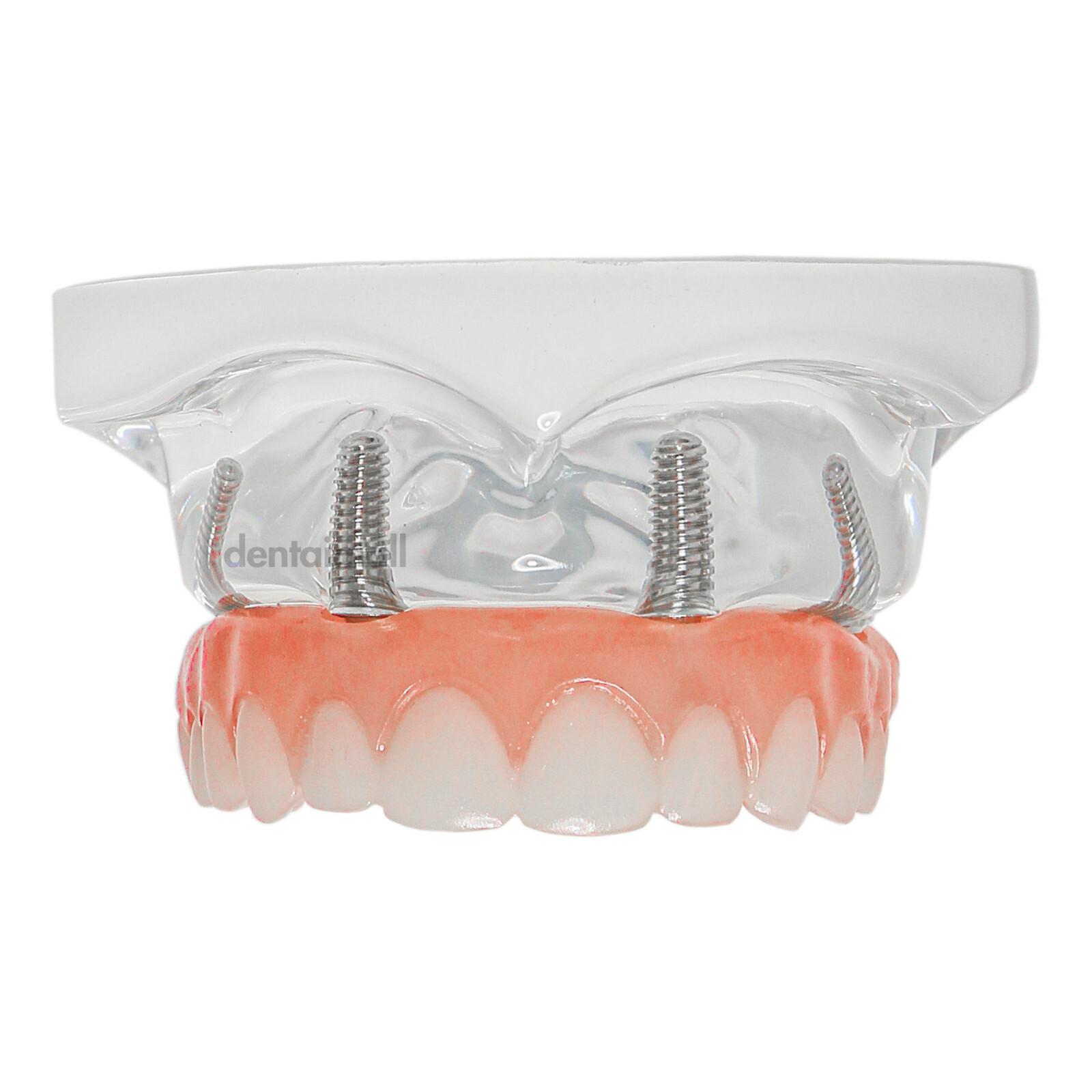 US Dental Overdenture Implant Model All-on-4 With 4 Screw Upper/Lower Clear Jaw