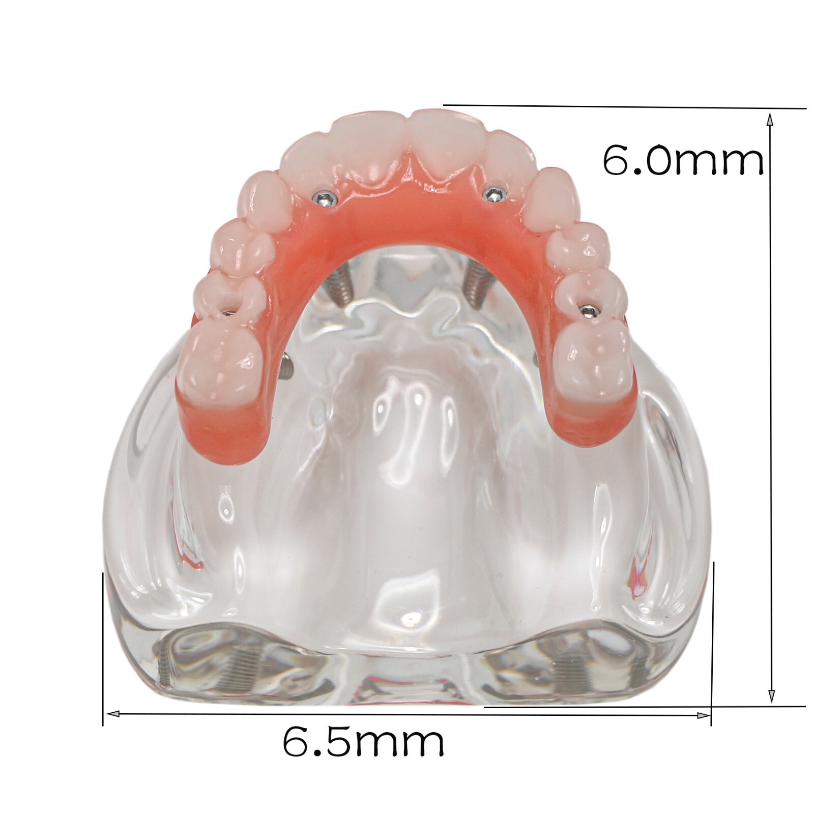Dental All-on-4 Overdenture Implant Model, Upper/Lower Jaw-Clear,With 4 Screw