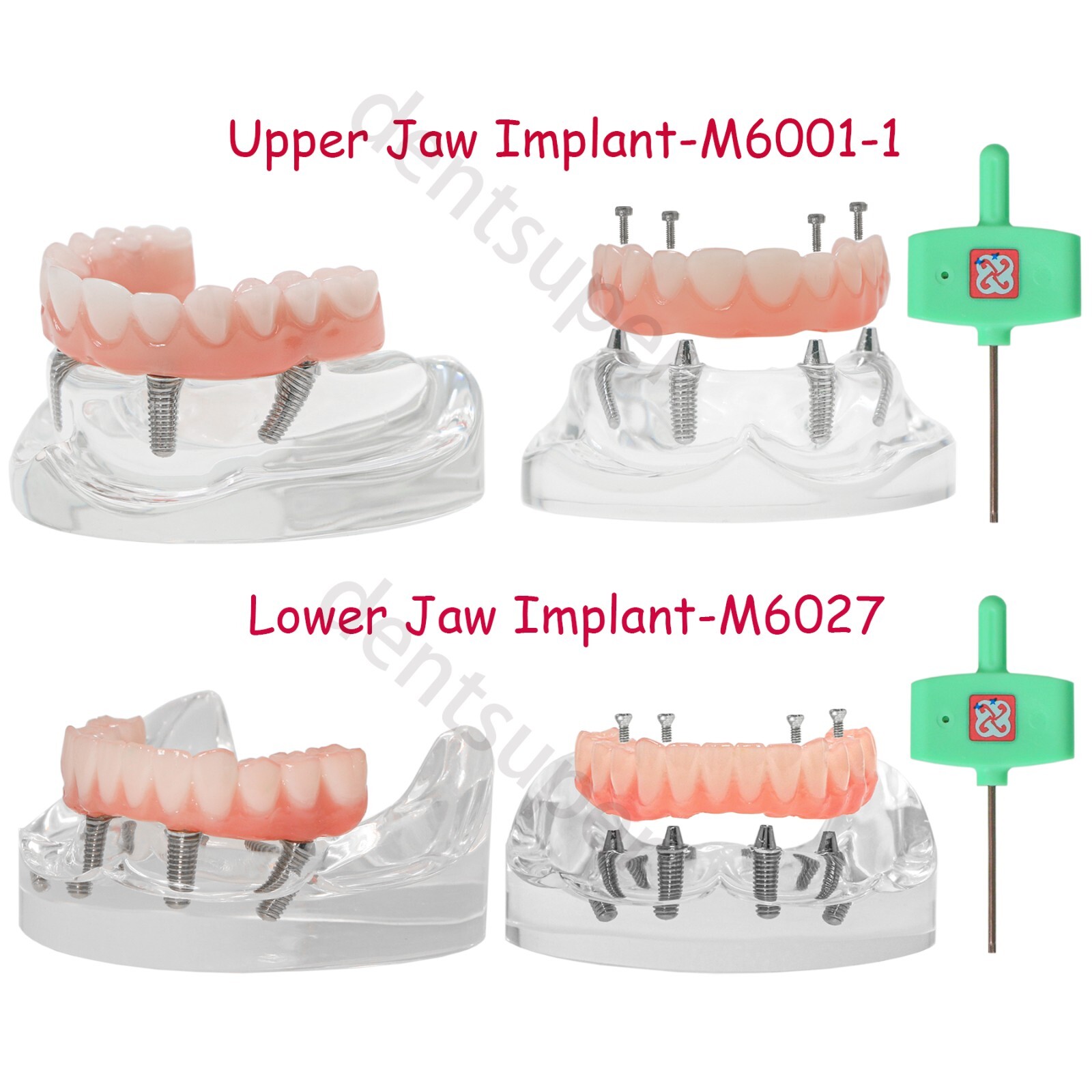 All-on-4/6 Screws Restoration Overdenture Dental Implant Model Upper/Lower Jaw