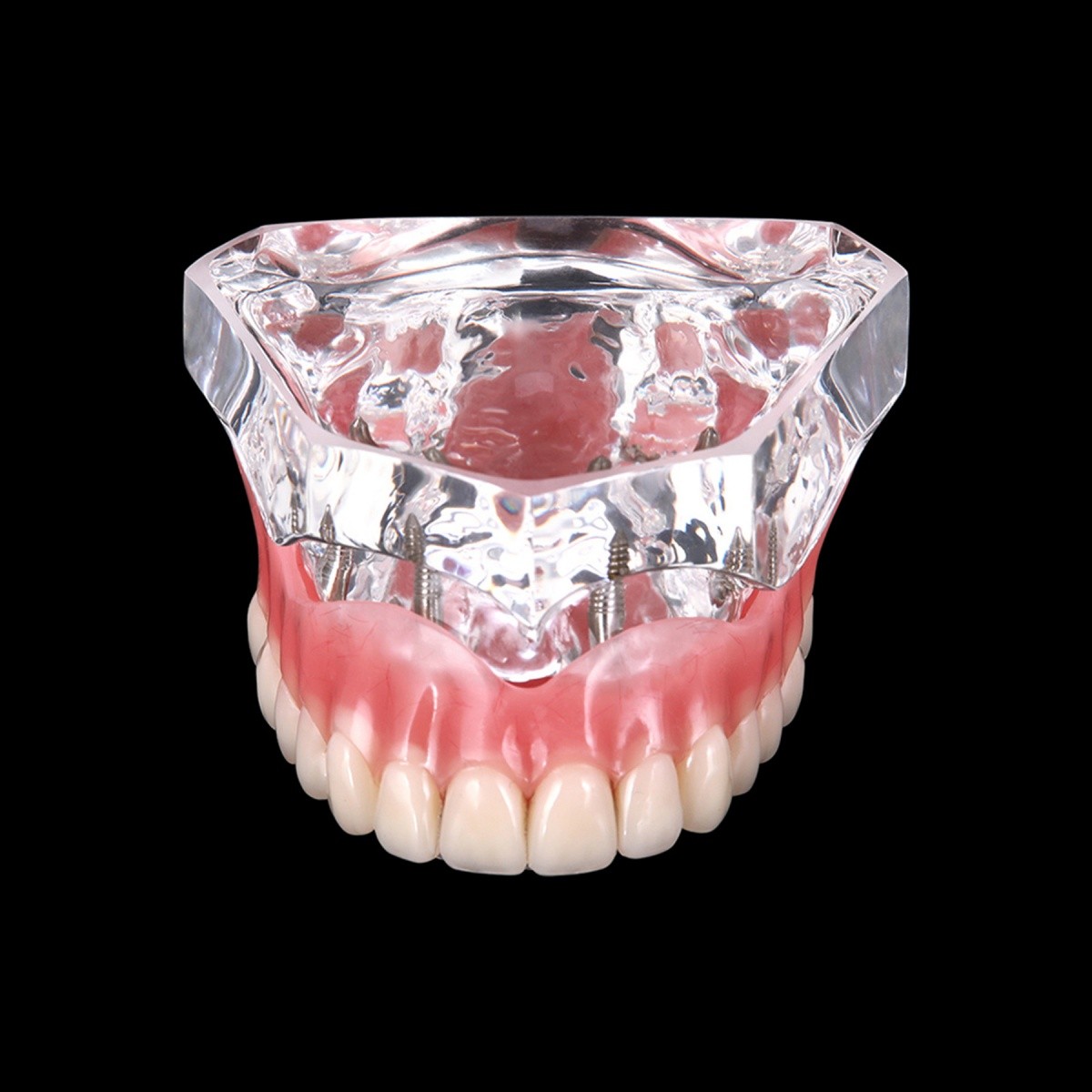 4 Implants Upper Lower Implant Teeth Model Dental Overdenture Restoration Model