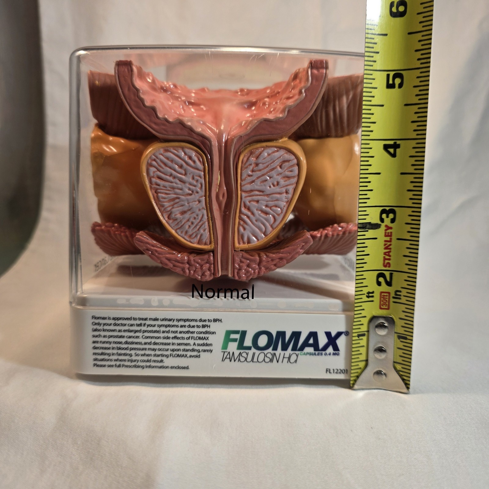 Human Prostate Anatomical Display Model Set Normal Mild/Severe BPH/Cancer