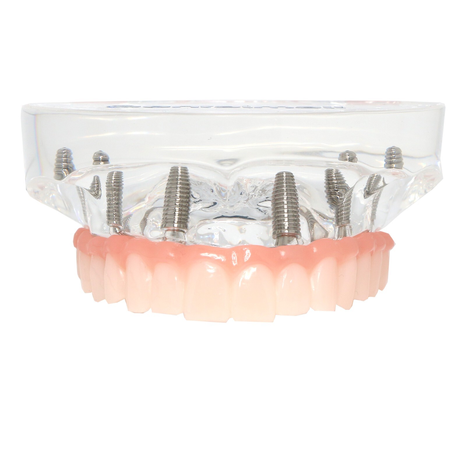 All-on-4/6 Screws Restoration Overdenture Dental Implant Model Upper/Lower Jaw
