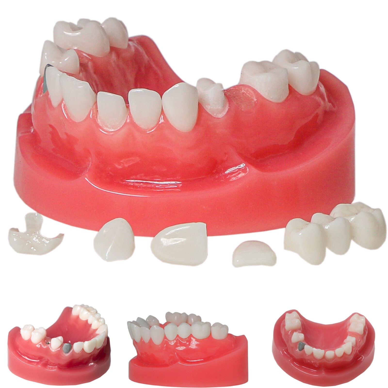 Dental Implant Model Upper Lower Jaw Demo All on 4/6 Overdenture treatment model