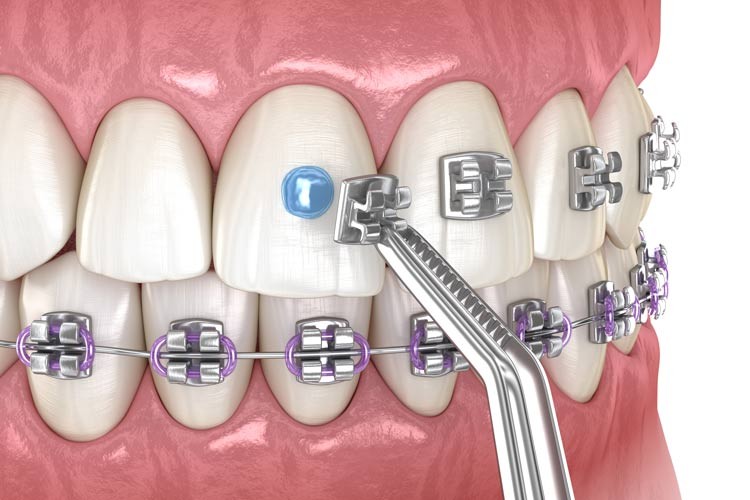 D-Tech Embrace LC Orthodontic Bonding Kit