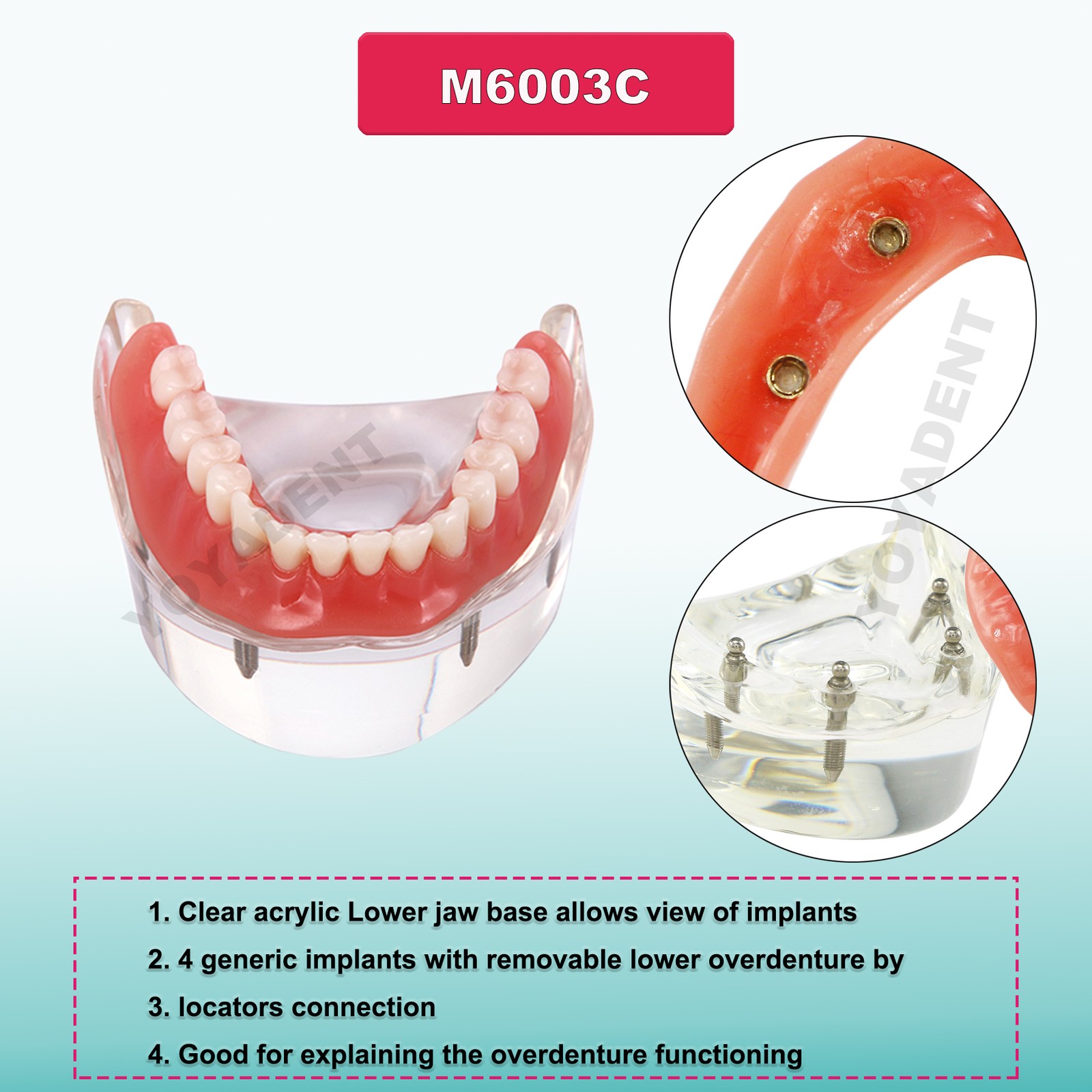 US Dental Implant Teeth Model Overdenture Restoration With4 Implants Upper Lower