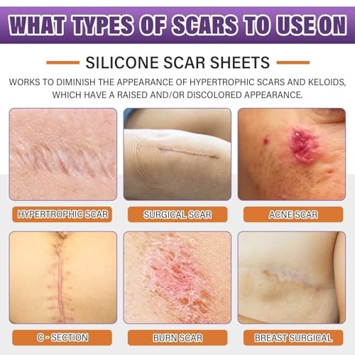 Medical Grade Silicone Scar Tape Roll 1.6″ x 59″ Reusable Sheet for Surgery Burn