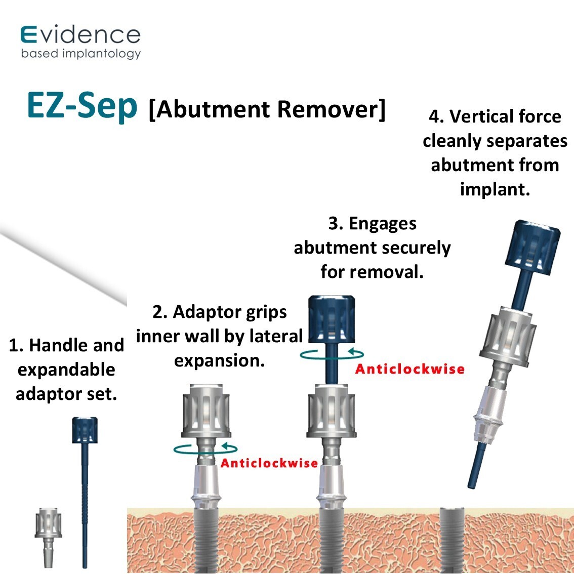Evidence Implant EZ-SEP (Abutment Remover)