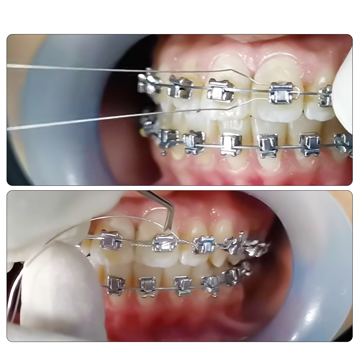 Alambre de Ortodoncia Dental Preformado Ligadura Ataduras Acero Larga Corta Tors