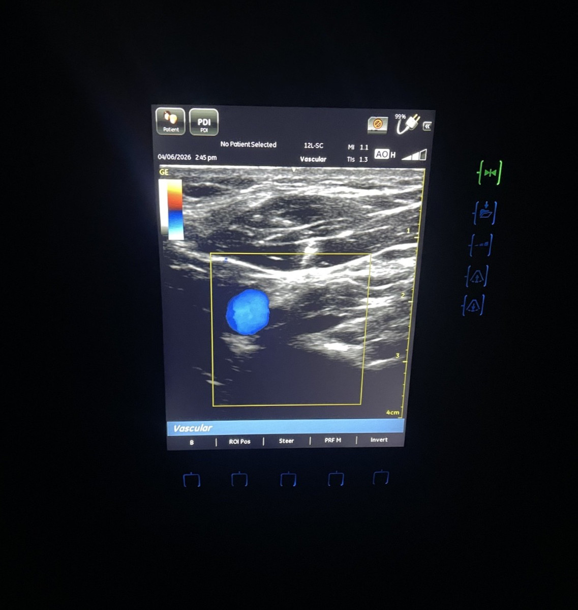 GE VENUE 40 Vascular Portable Ultrasound W/ 12L-SC Probe and docking station