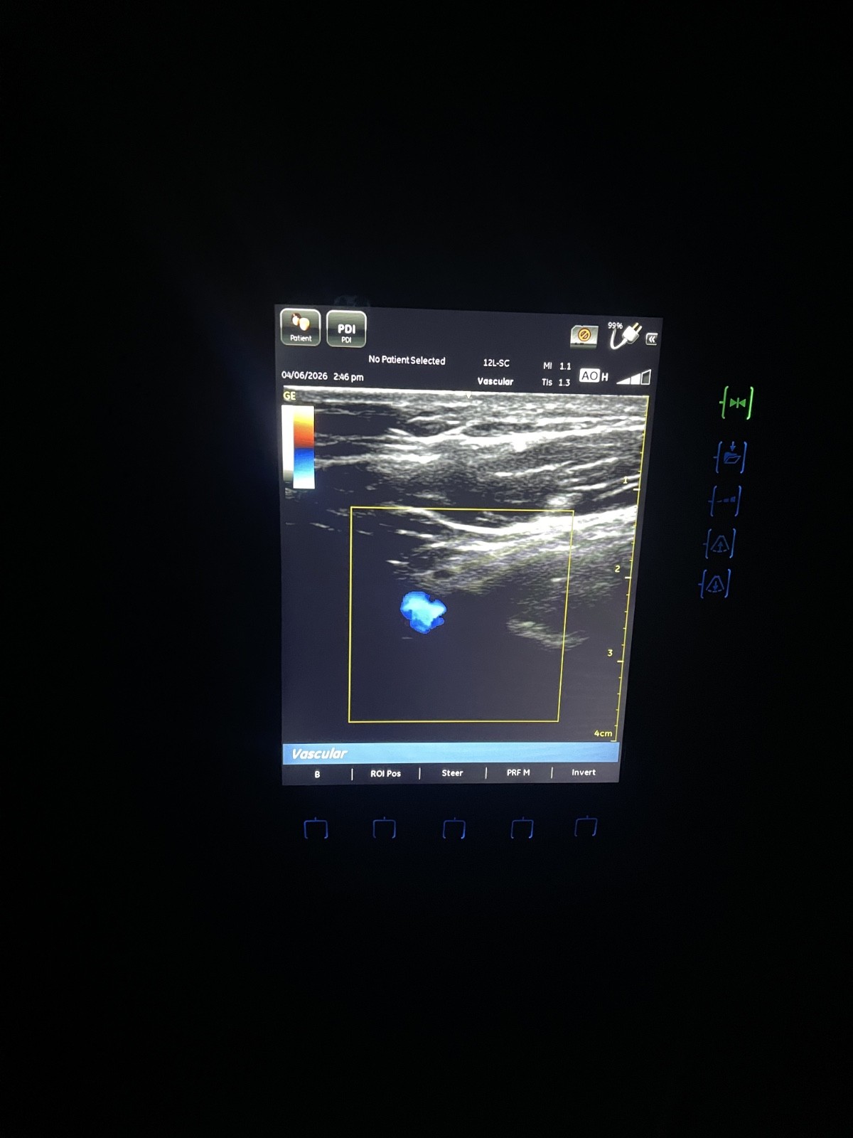 GE VENUE 40 Vascular Portable Ultrasound W/ 12L-SC Probe and docking station