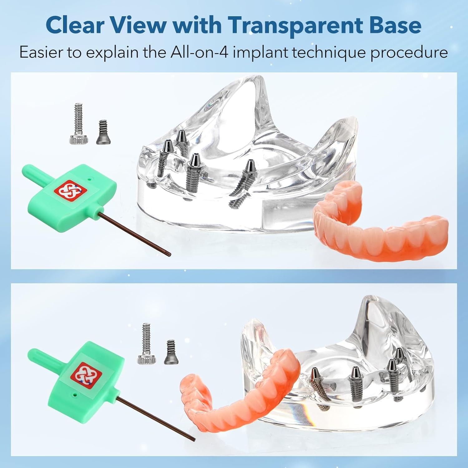 New Dental Implant Model All-on-4 All-on-6 Overdenture U/L Jaw 4/6 Screws Clear