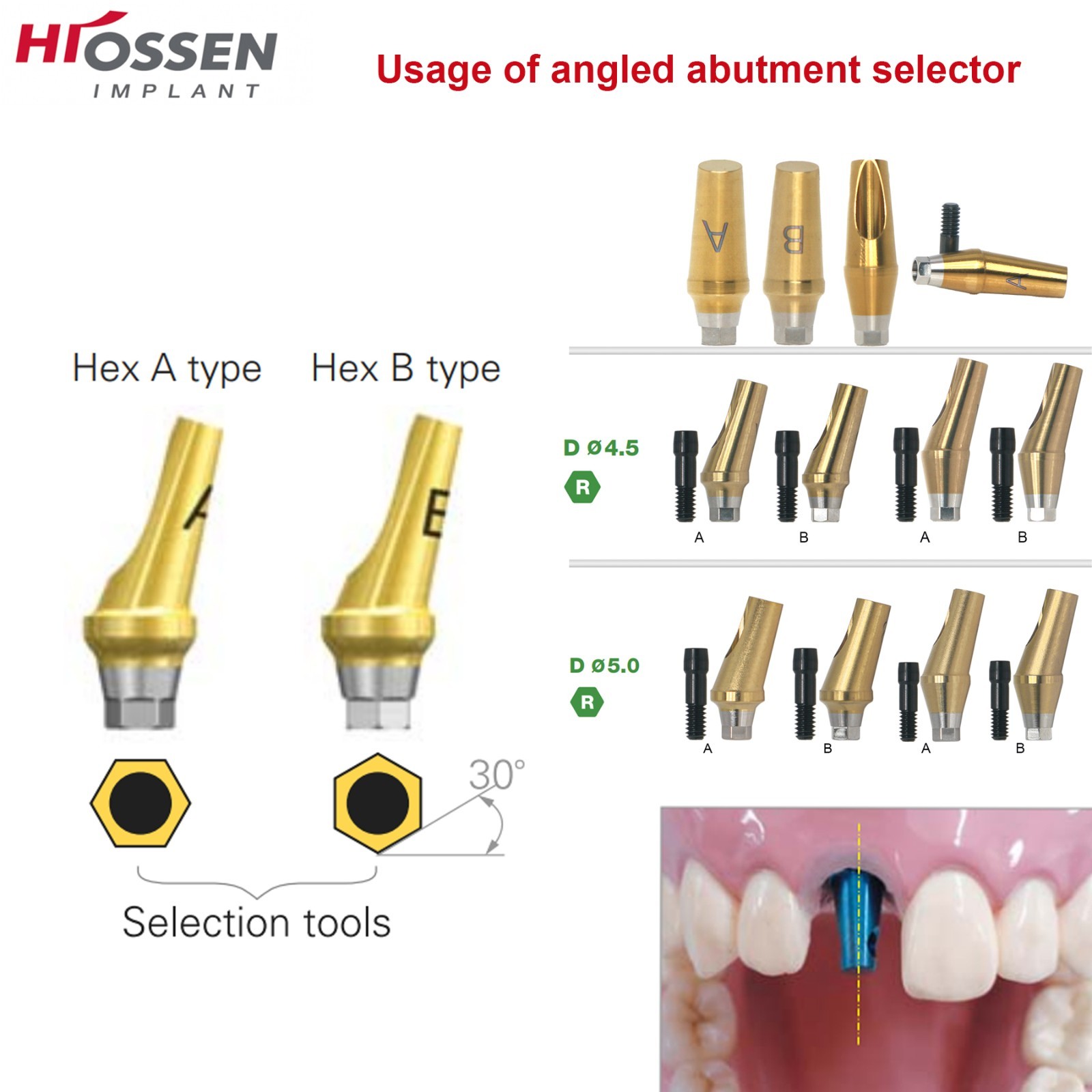 US 17° Angulated Abutment Regular Hex A/B Type For Osstem TS Regular Platform Ti