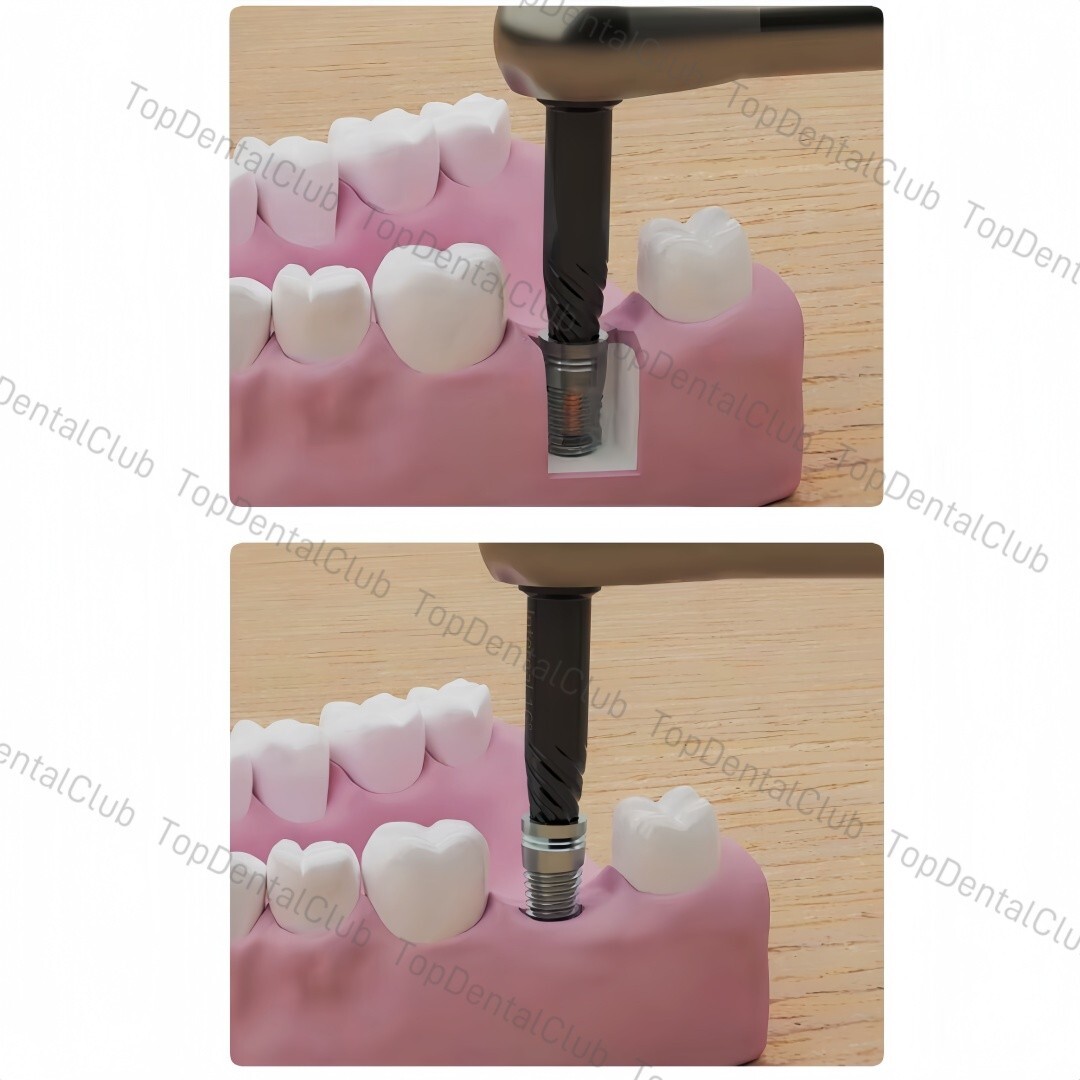 Dental Fixture Remover Screw Broken Implants Pick Up Extractor Failed SOS Screws