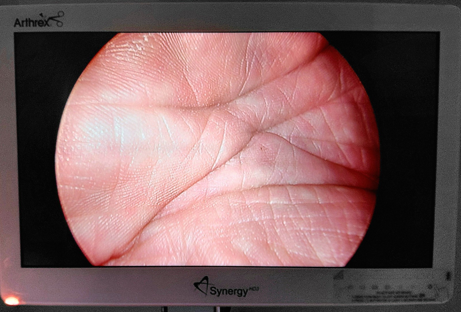 Richard Wolf 8915.402 Panoview Plus Laparoscope, 0°, 10mm, 5mm Working Channel