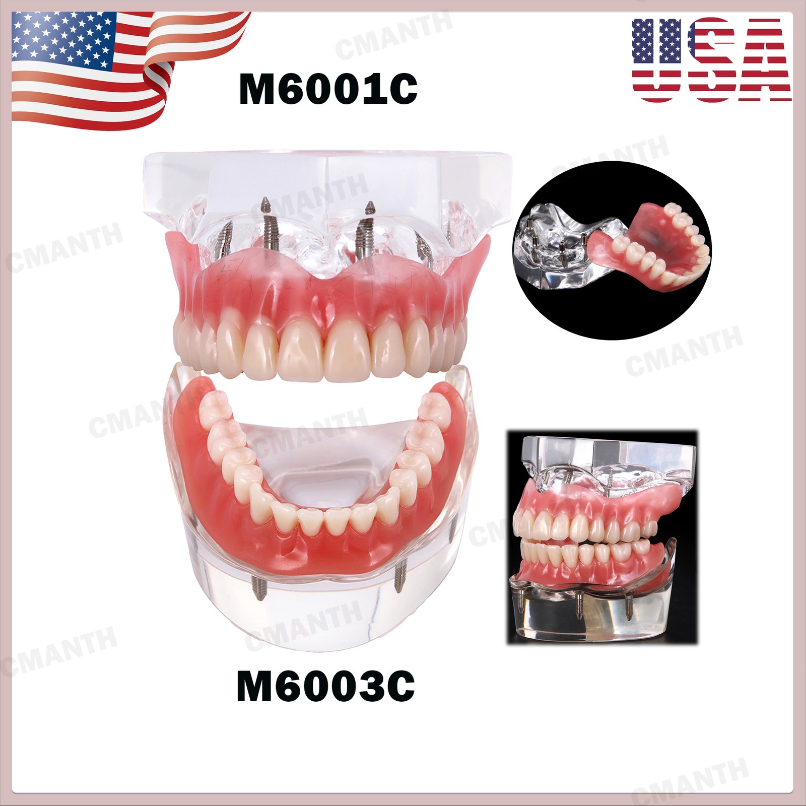US Dental Model Upper Lower Jaw 4 Overdenture Practice Implant Typodont Demo