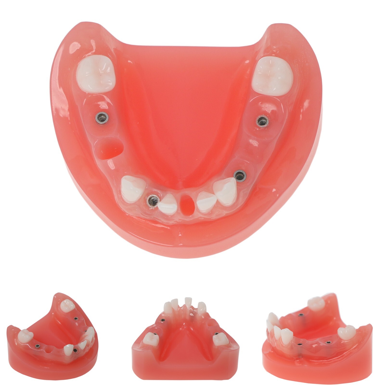 Dental Implant Model Upper Lower Jaw Demo All on 4/6 Overdenture treatment model