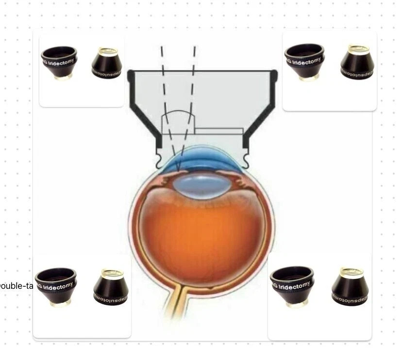 Hospital Ophthalmology YAG Laser Capsulotomy & YAG Iridectomy Combo Lens Set 2