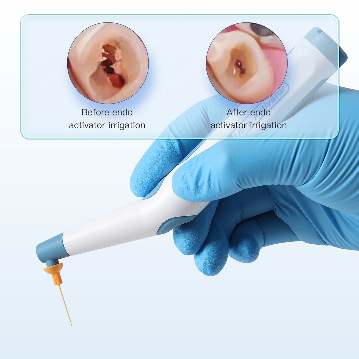 Dental Endo Ultrasonic Sonic Activator Root Canal Irrigator+60Tips/150tips