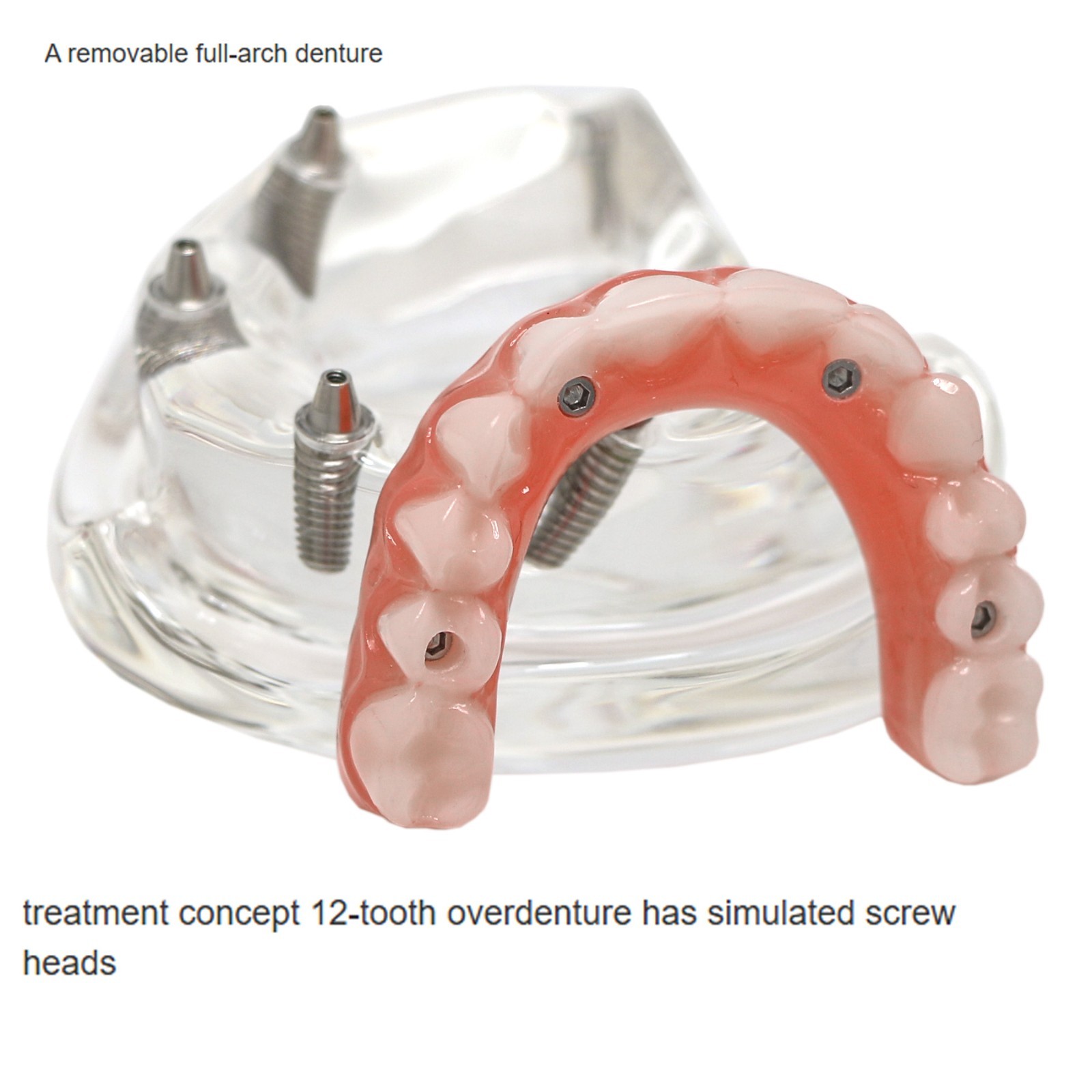 All-On-4 Dental Implant System Overdenture Treatment Teeth Model U/L Jaw W/screw