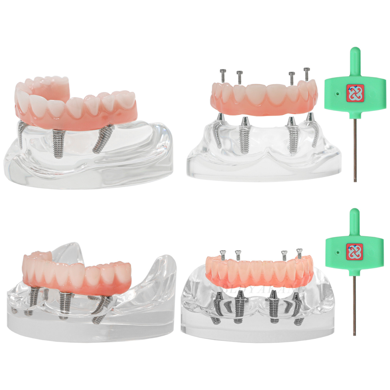 US Dental Overdenture Implant Model All-on-4 With 4 Screw Upper/Lower Clear Jaw