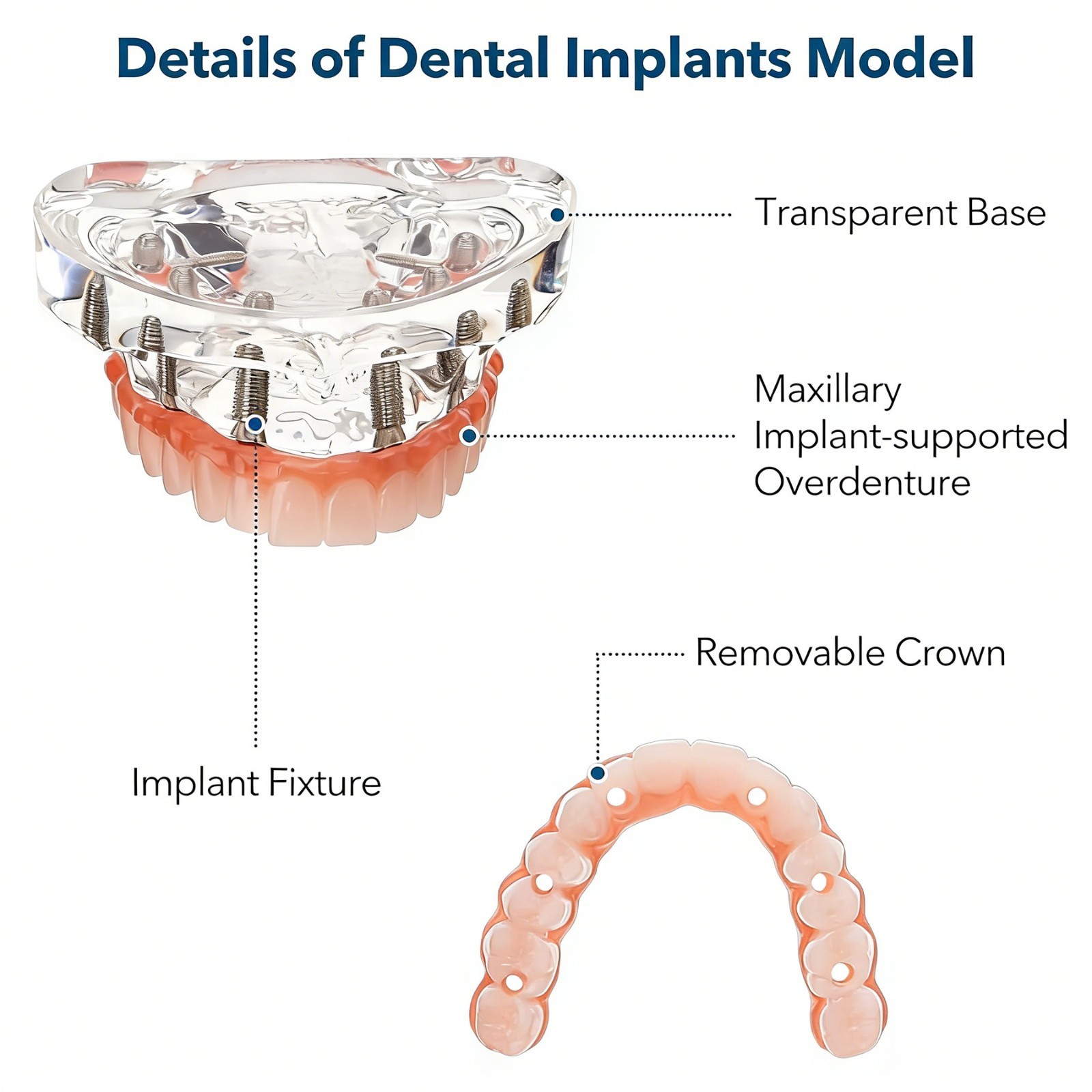 US Dental Implant Overdenture Model All-on-4/6 Upper Jaw Restoration 4/6 Screws