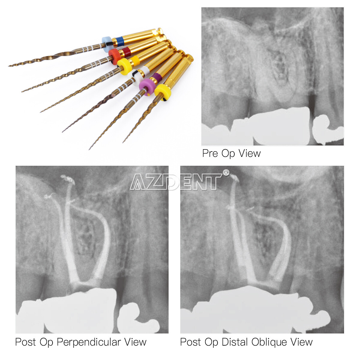 Limas rotatorias NITI para endodoncia dental Uso del motor Gold Taper SX-F3 25mm