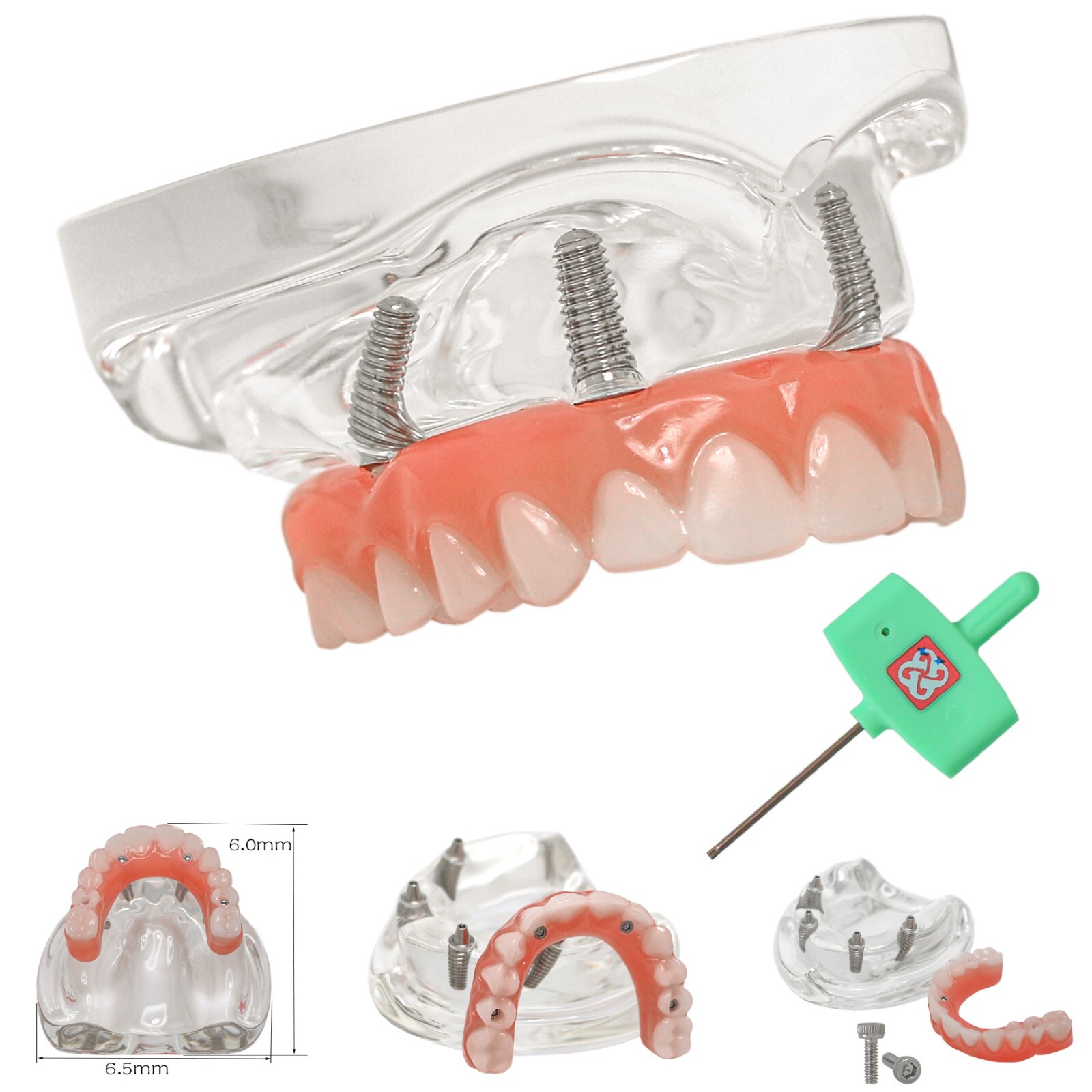 Dental Implant Model Upper Lower Jaw Demo All on 4/6 Overdenture treatment model