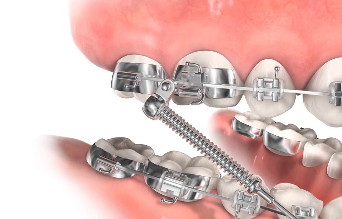 Orthodontic Dental Class II Malocclusion Appliances Fatigue Resistant Device