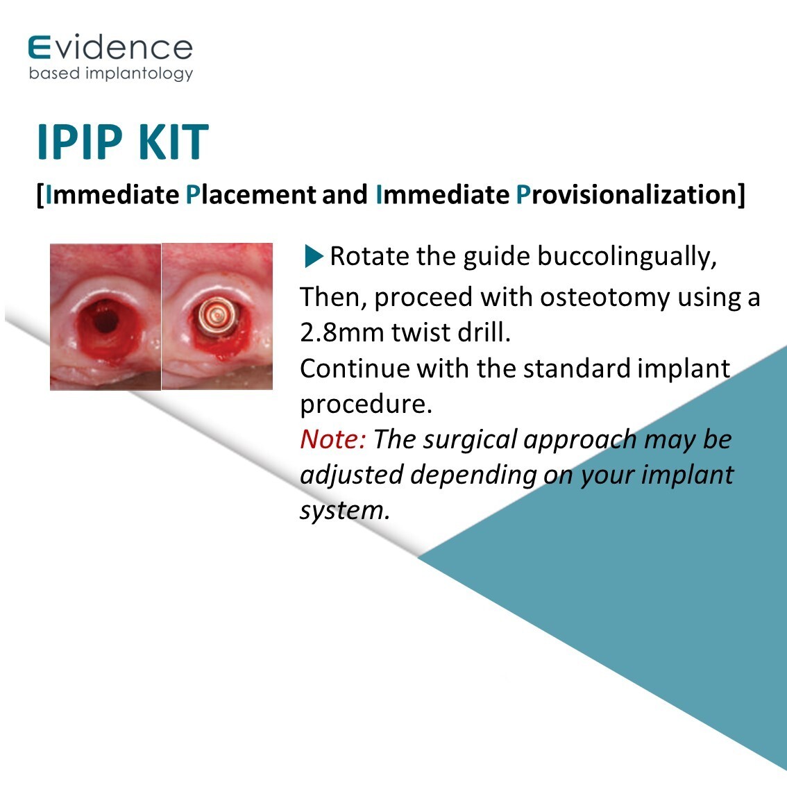 Evidence Implant IPIP Kit