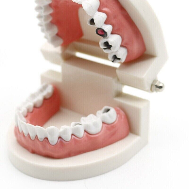 5 Pcs Dental High Quality Material Decay Standard Teeth Teach Adult Caries Model