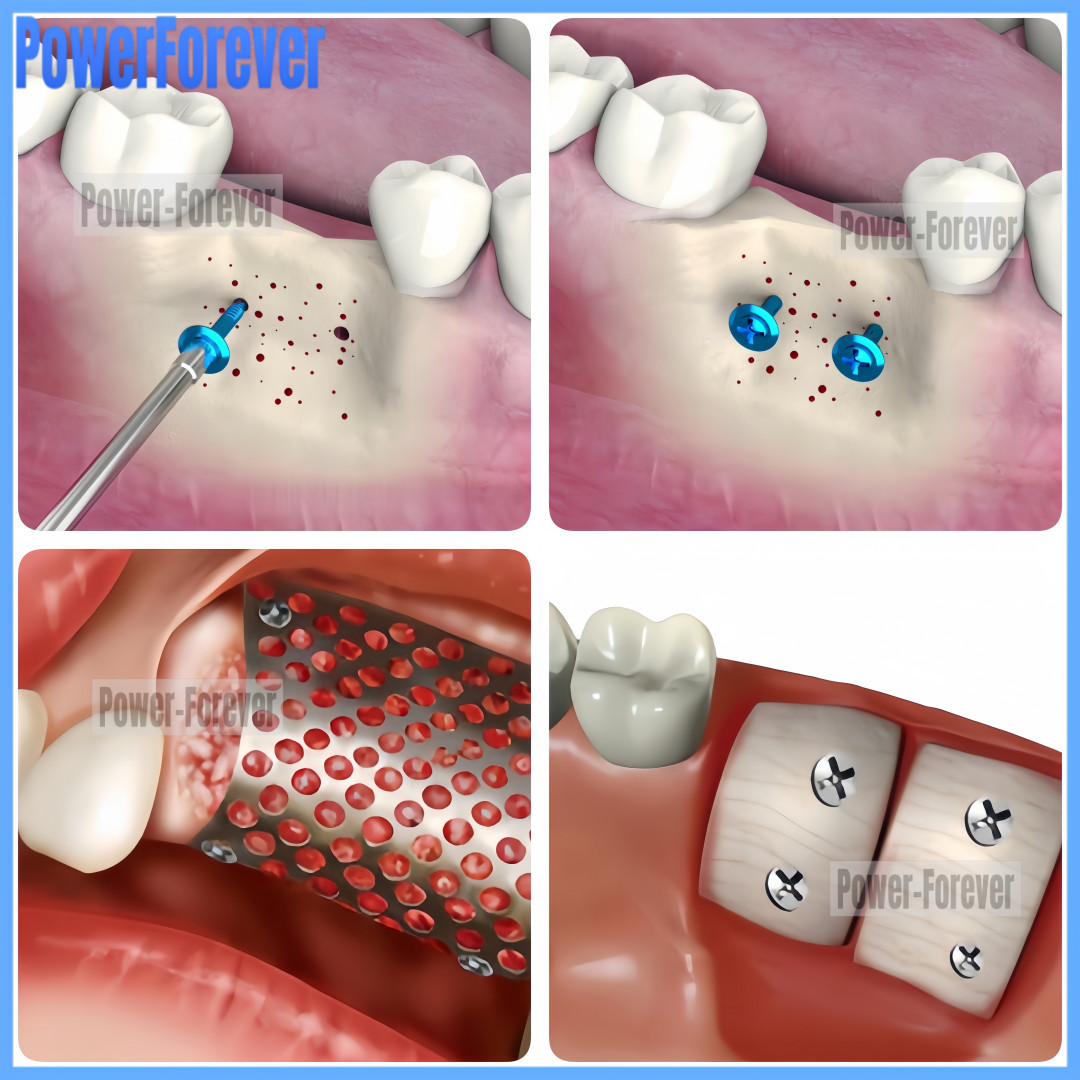 USA Dental GBR Bone Tent Screw Driver Fixation Guide Regeneration Membrane
