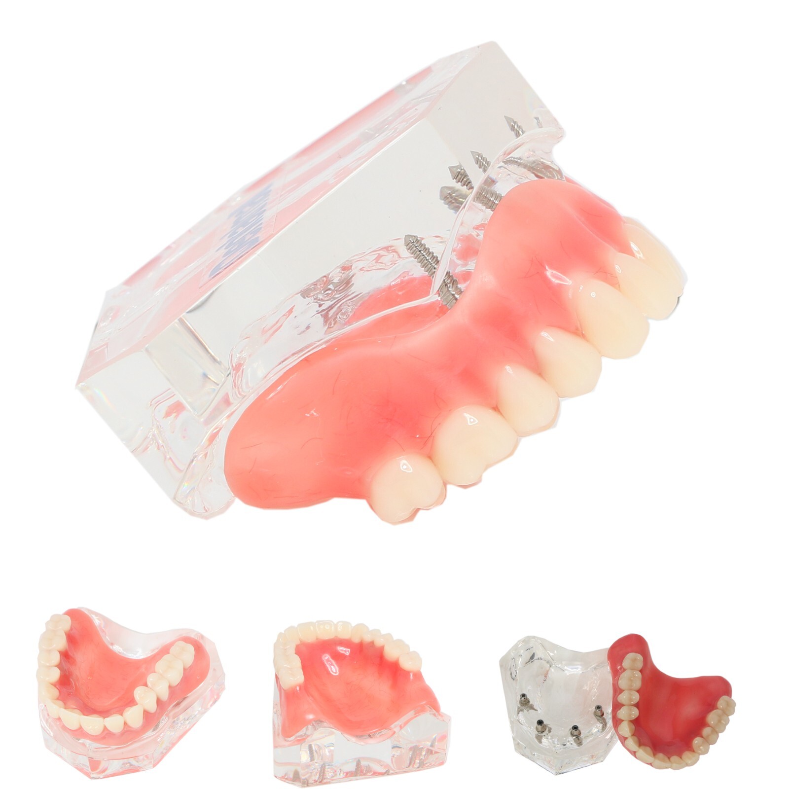 Dental Implant Model Upper Lower Jaw Demo All on 4/6 Overdenture treatment model