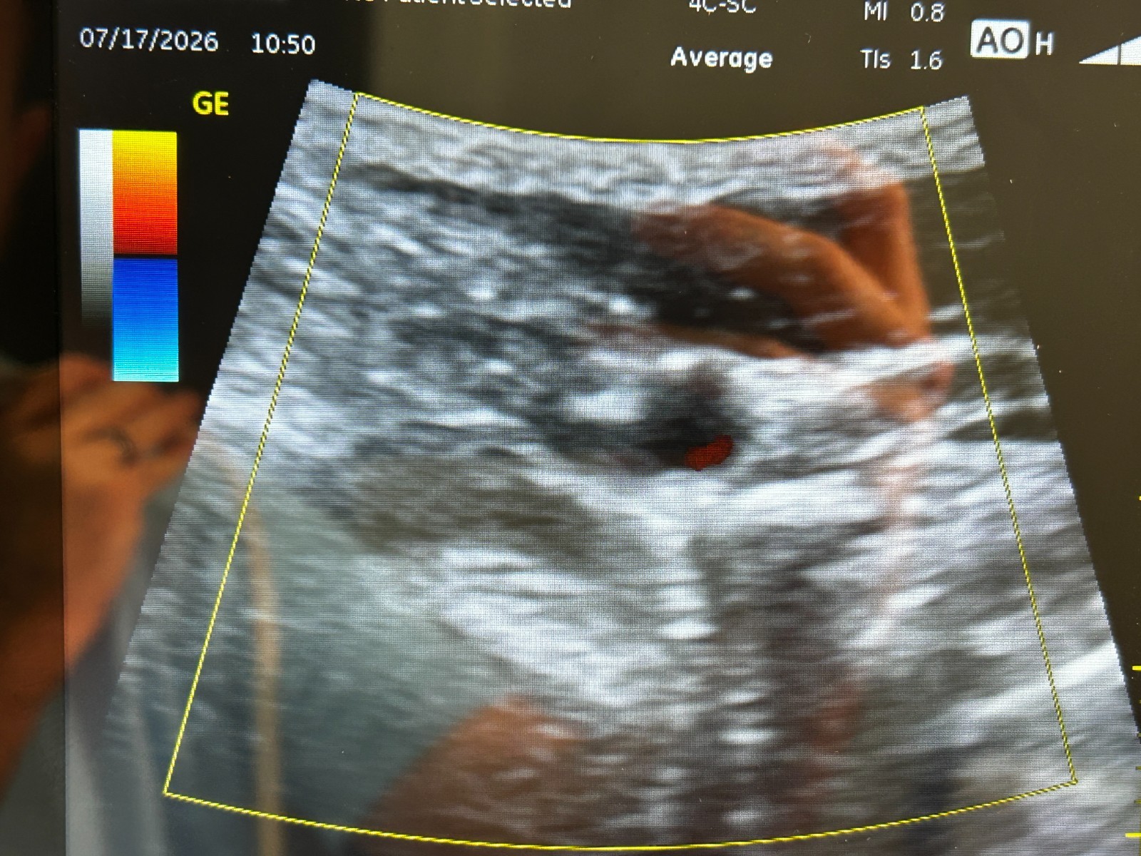 GE Venue 40 Anesthesia Ultrasound with GE 4C-SC Transducer