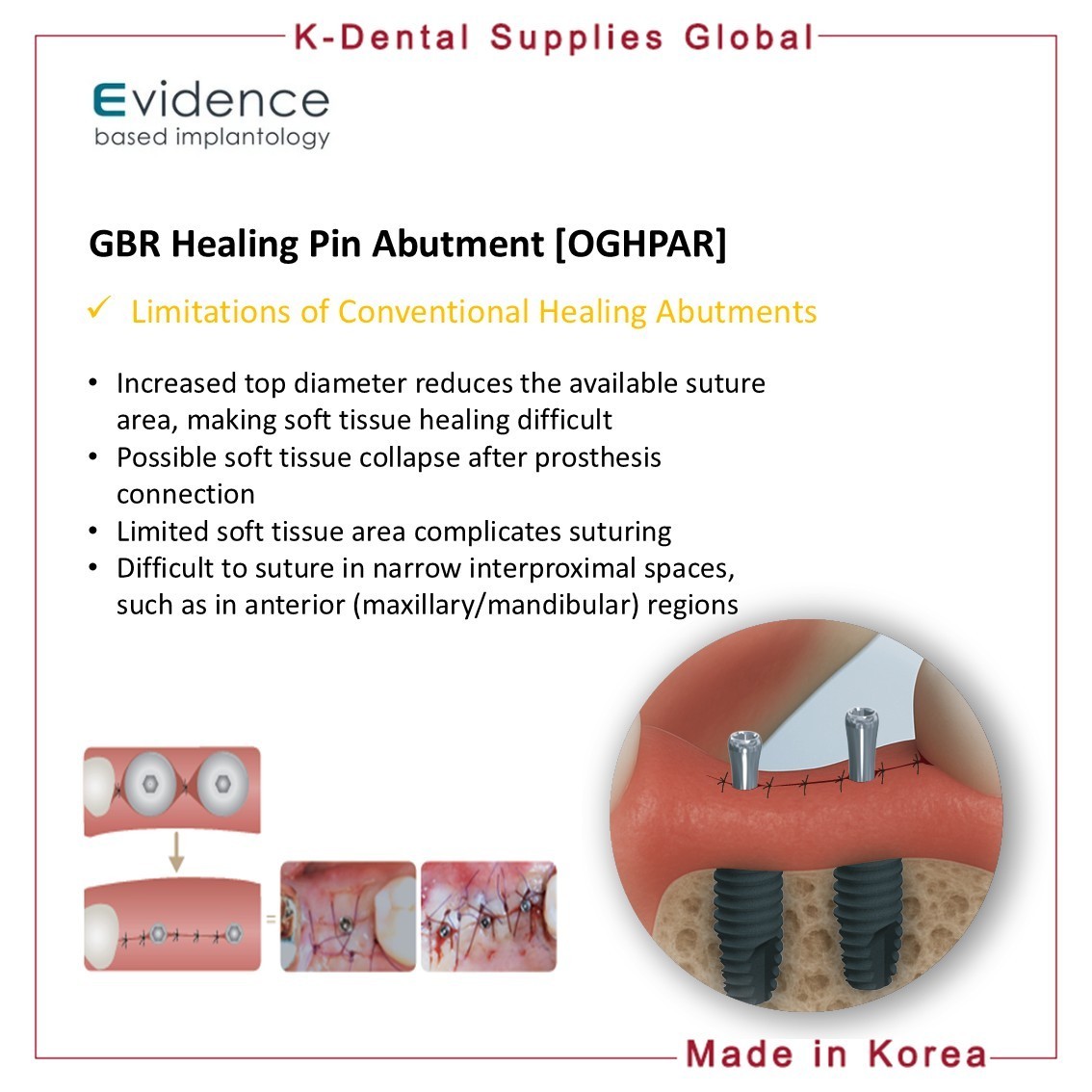 Evidence GBR Healing Pin Abutment