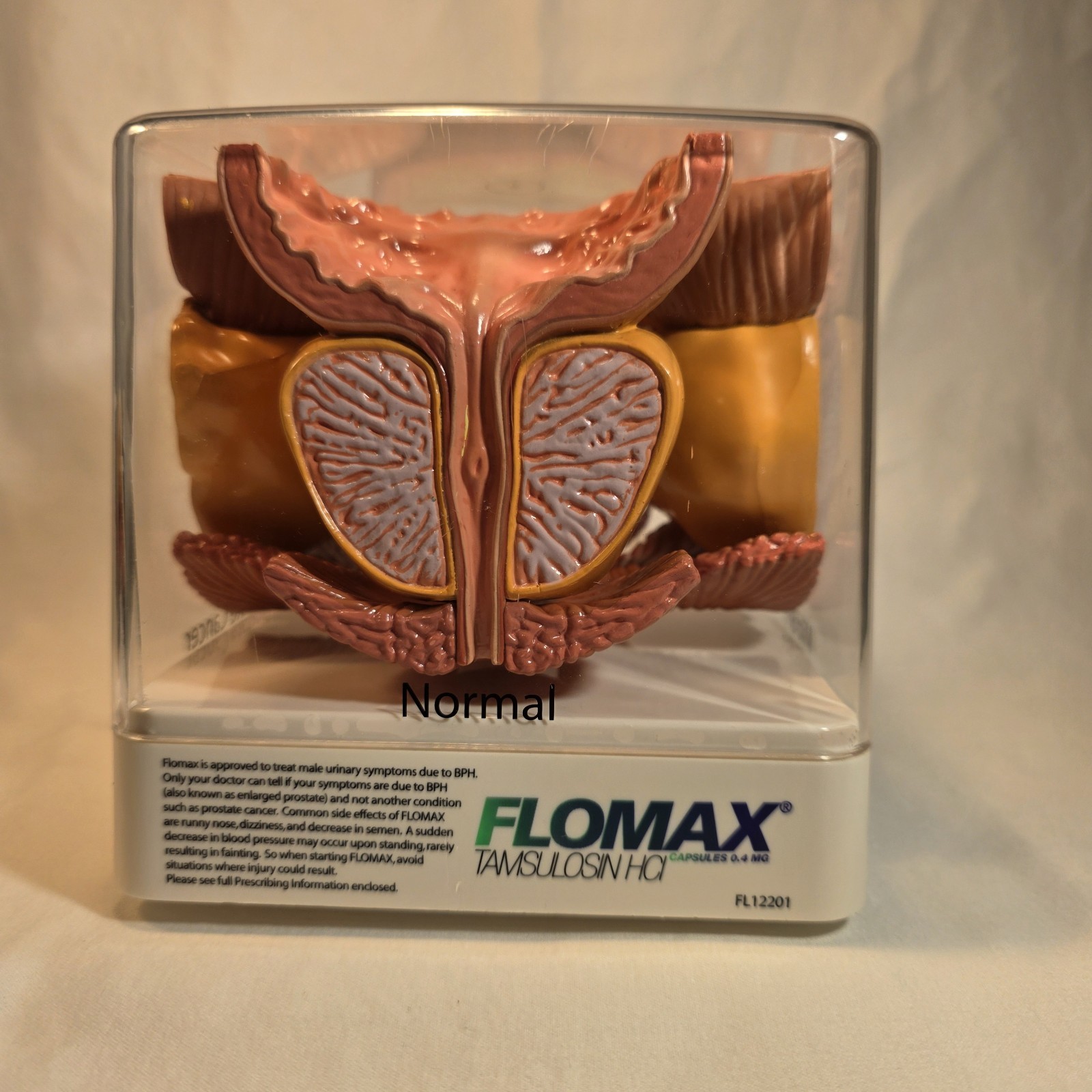 Human Prostate Anatomical Display Model Set Normal Mild/Severe BPH/Cancer